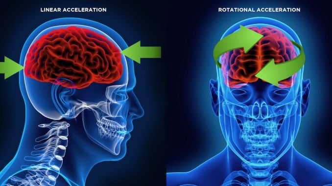 Linear and rotational acceleration are two challenges in reducing traumatic brain injury (TBI)