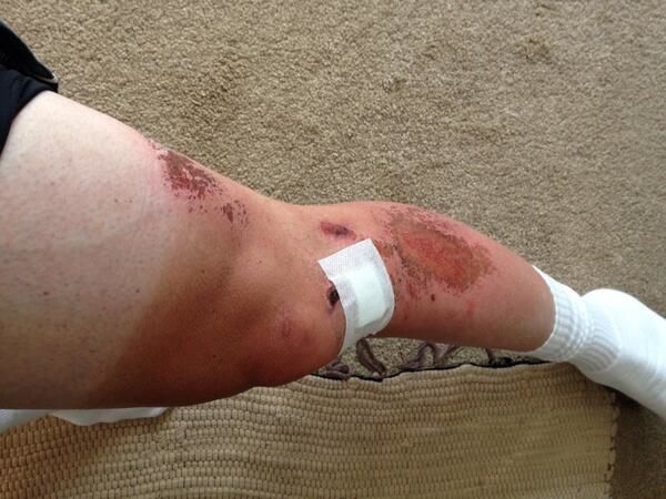 Road rash on cyclist with shaved legs